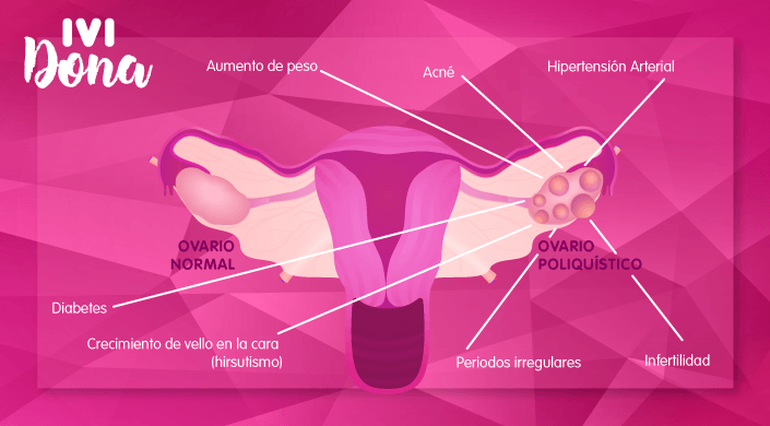 ¿Qué es el temido síndrome del ovario poliquístico? [Infografía]
