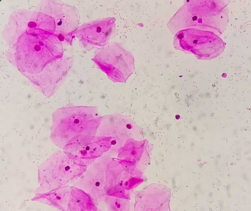 infección vaginal