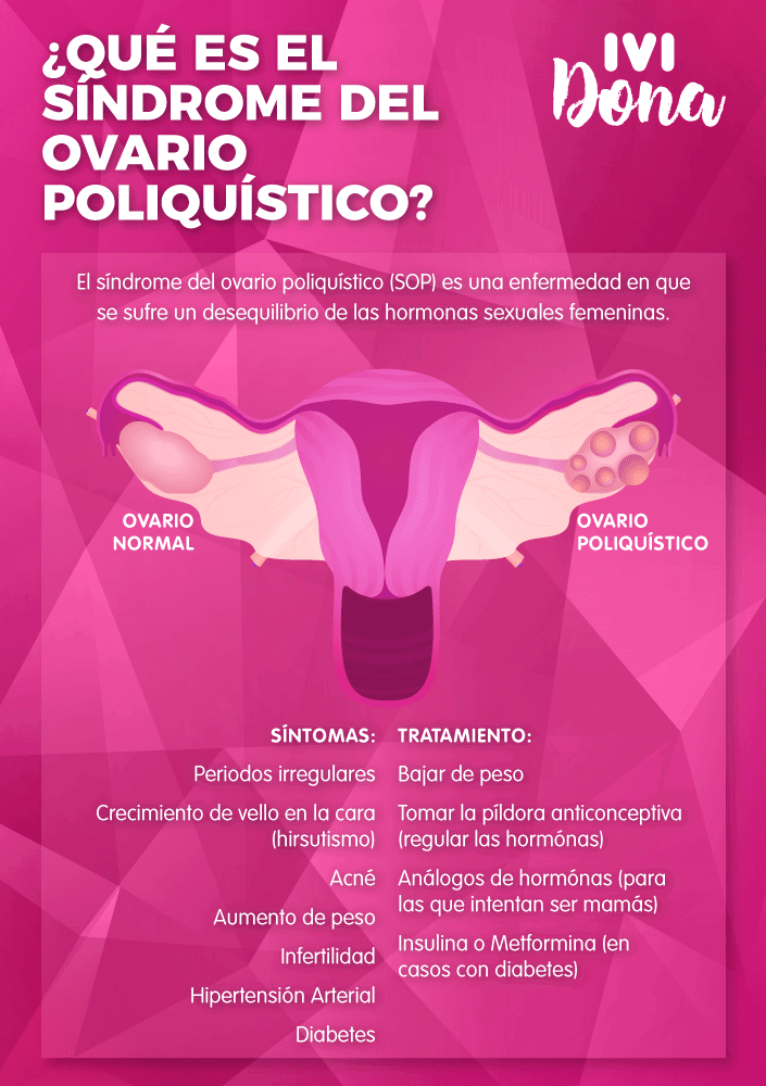 sindrome del ovario poliquistico-infografia