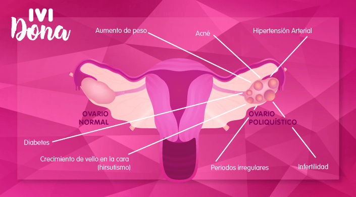 sindrome del ovario poliquistico-portada