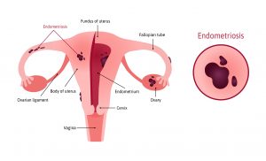 síntomas de la endometriosis